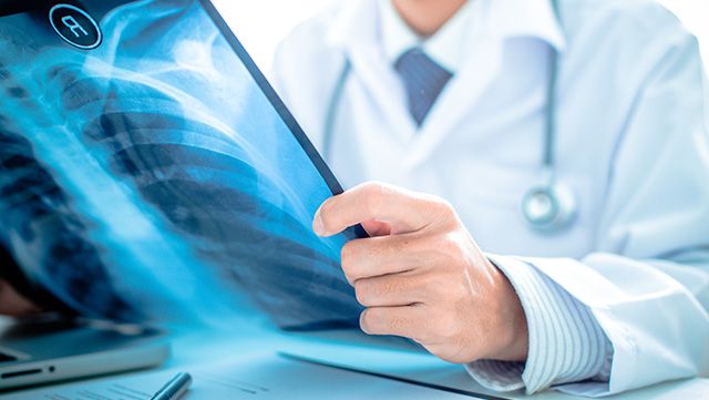 Doctor's hand holding a chest X-ray