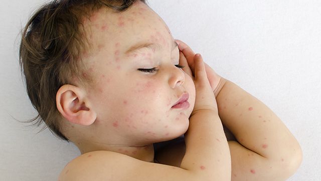 Hand, Foot and Mouth Disease (HFMD)