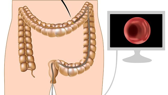 Illustration of a colonoscopy