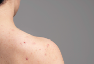 Close-up of a shoulder with acne and skin problems