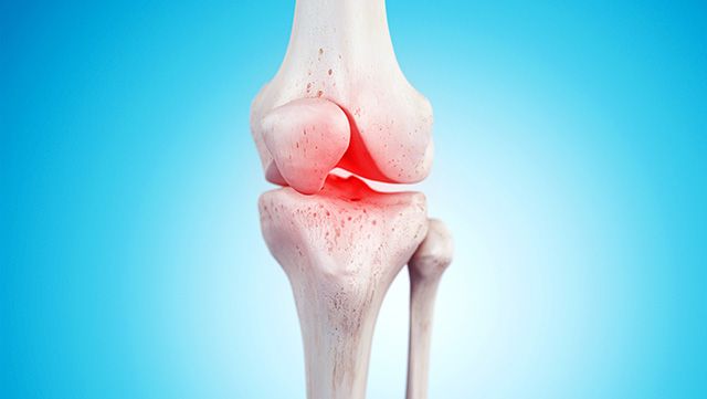 Illustration of gout in the knee joint