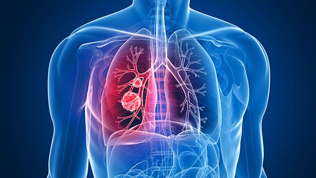 Illustration showing lung cancer inside the body