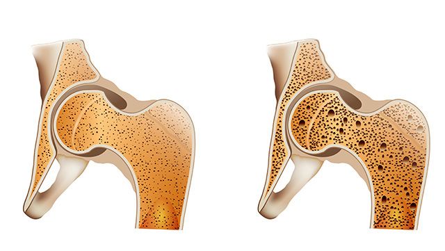 Illustration of the inside of the pelvis with and without osteoporosis