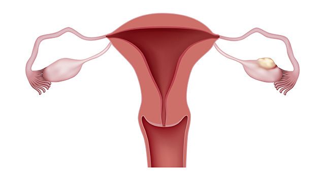 Illustration of ovarian cancer