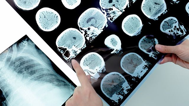 Hand holding diagnostic images of the brain
