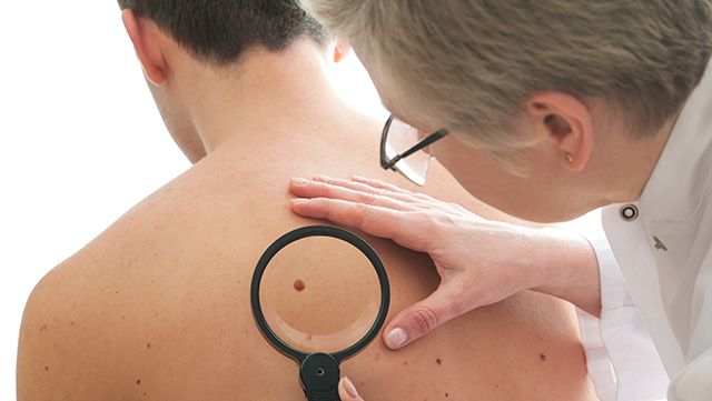 Doctor examining mole on a man's back with a magnifying glass