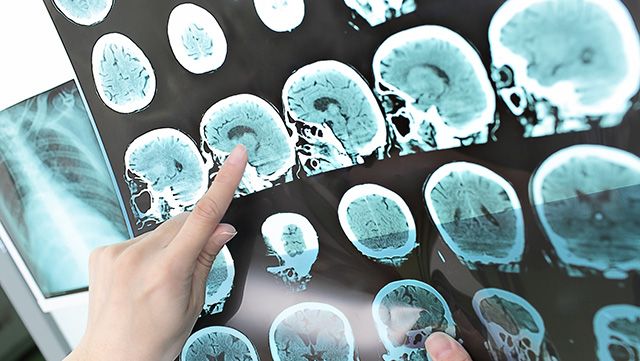 Hand pointing to diagnostic images of the brain