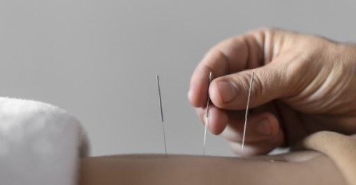 Acupuncture needles inserted into the stomach