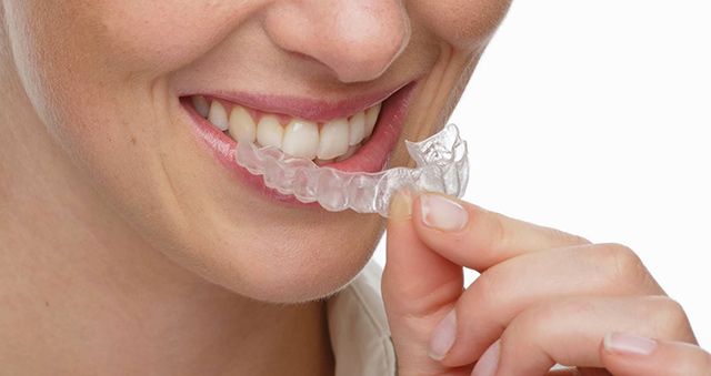 Woman inserting clear retainer into mouth