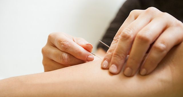 Acupuncture needles being inserted into forearm