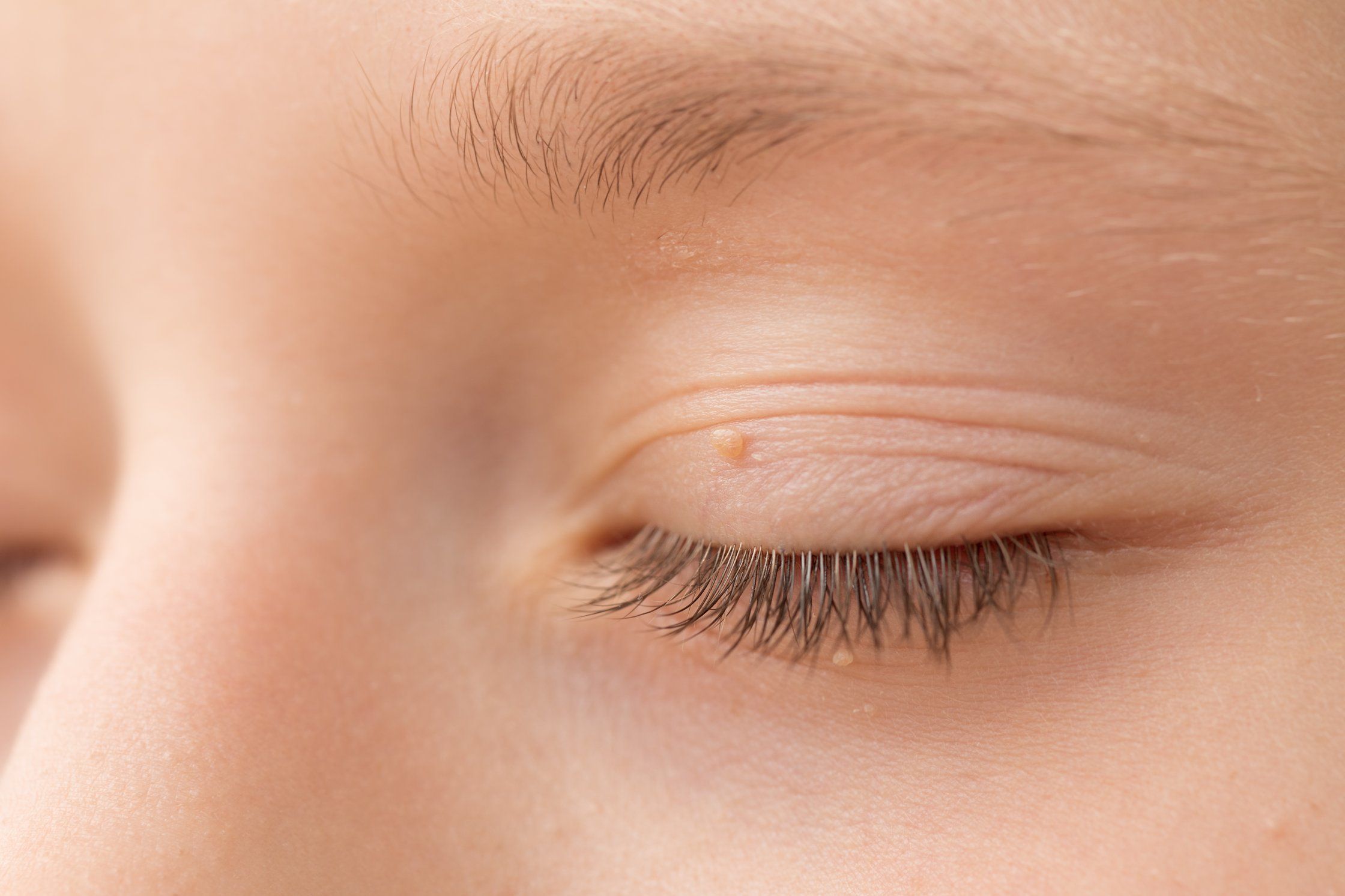 Close-up of a wart on a person's eyelid