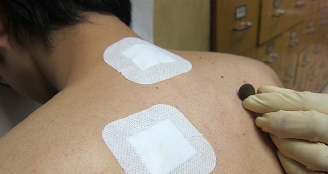 Tianjiu treatment patches on a patient's back