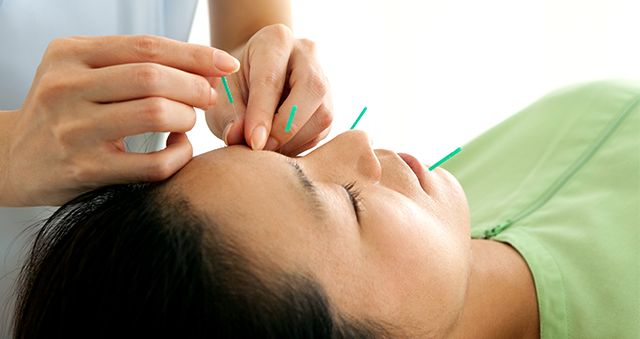 Woman receiving acupuncture to the face